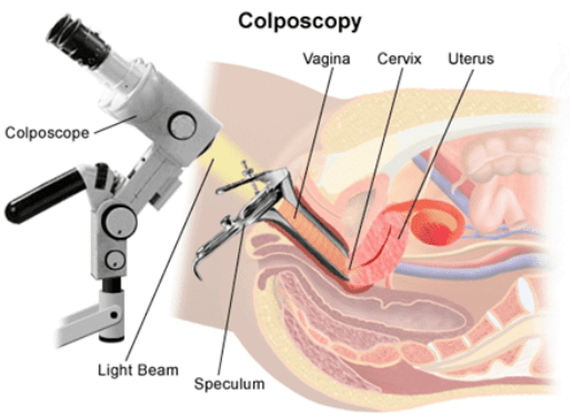 Image result for colposcopy