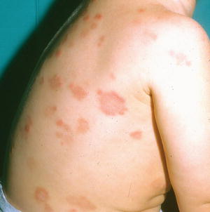 Autoinflammatory Syndromes | Obgyn Key