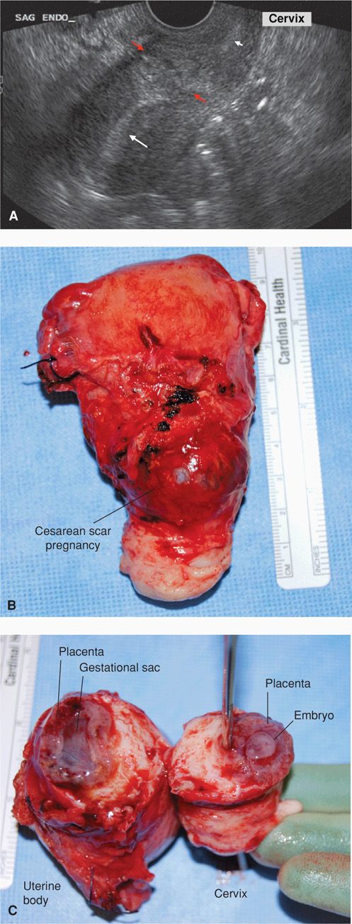 Ectopic Pregnancy