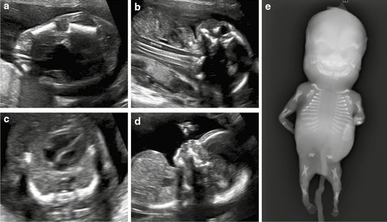 The Anomalies Of Fetus Ultrasound