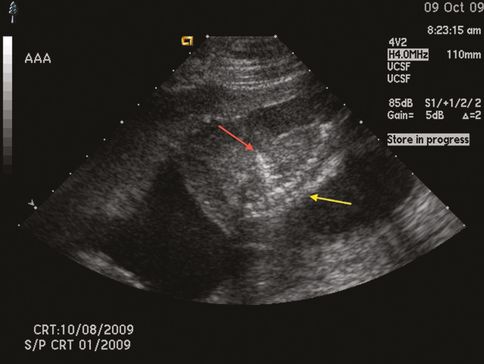 Fetal therapy | Obgyn Key