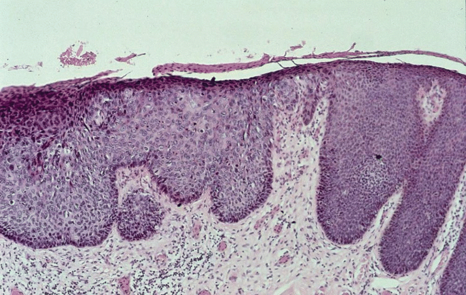 Micrograph of the undifferentiated VIN.