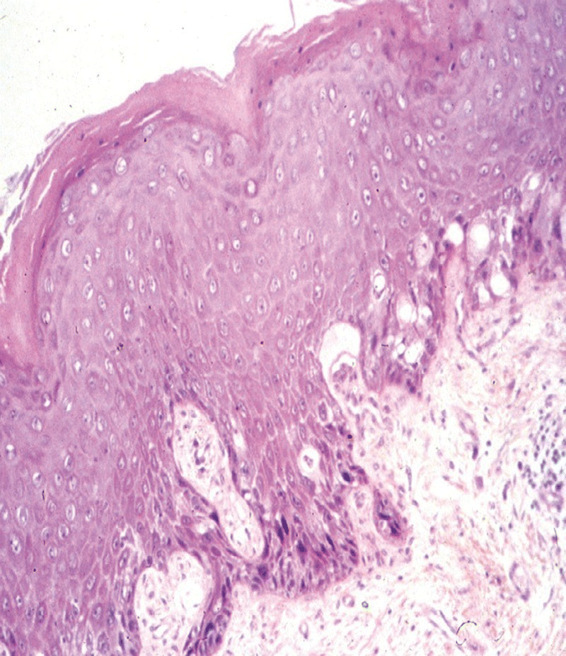 Micrograph of the differentiated VIN with atypical mitosis in the basal layer, basal cellular atypia, dyskeratosis, prominent nucleoli, and elongation and anastomosis of the rete ridges.