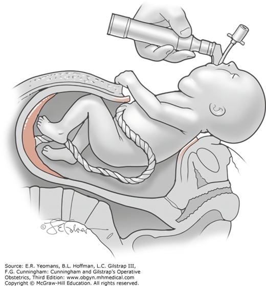 Fetal Therapy | Obgyn Key