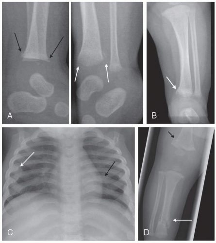 Diagnosis and Management of Child Abuse Injuries | Obgyn Key