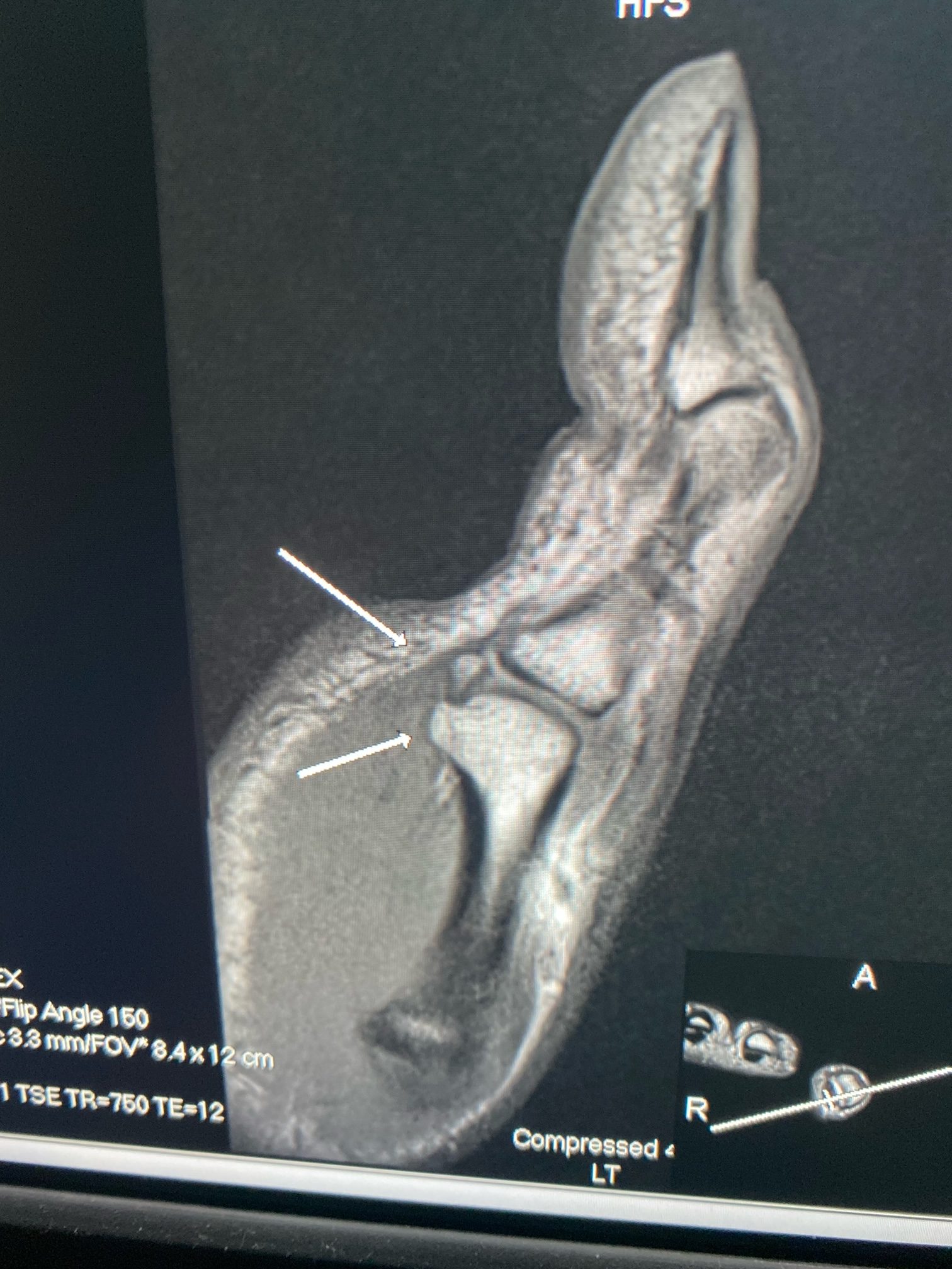 Locked sesamoid at thumb mcp joint OCAD