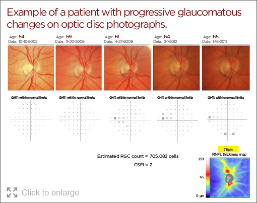 Glaucoma Eye Drop Charts - Download Artistic Sunset Art | Desktop