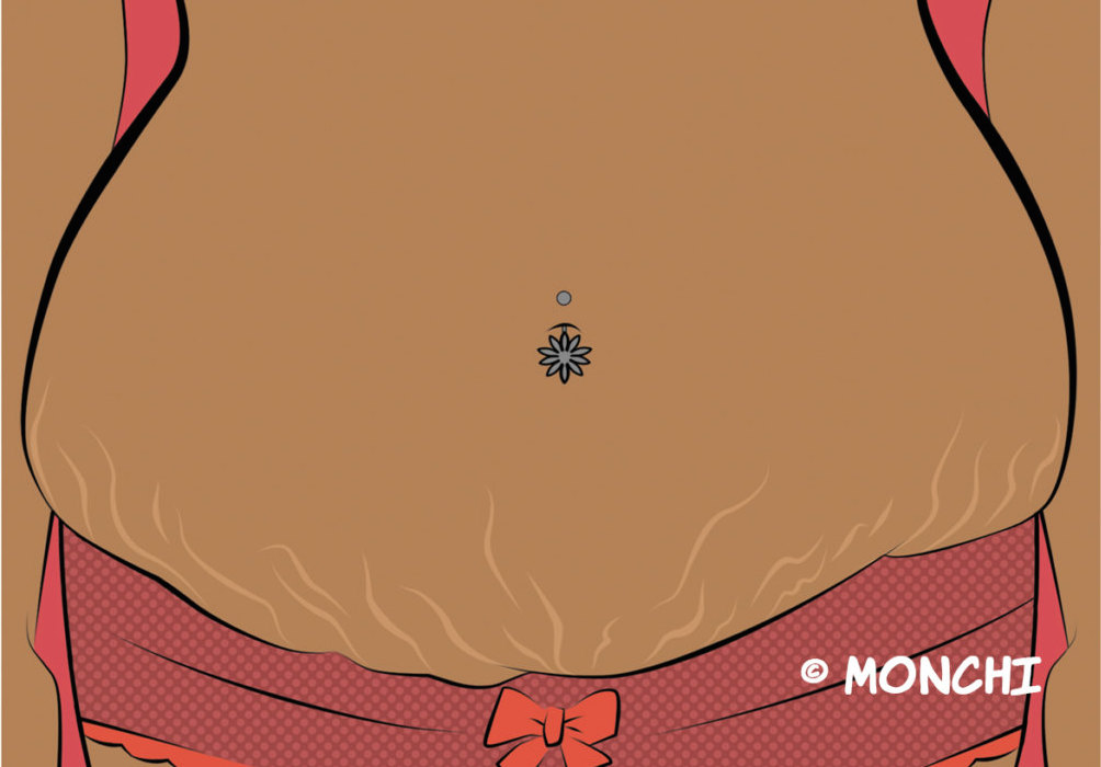 stretch marks