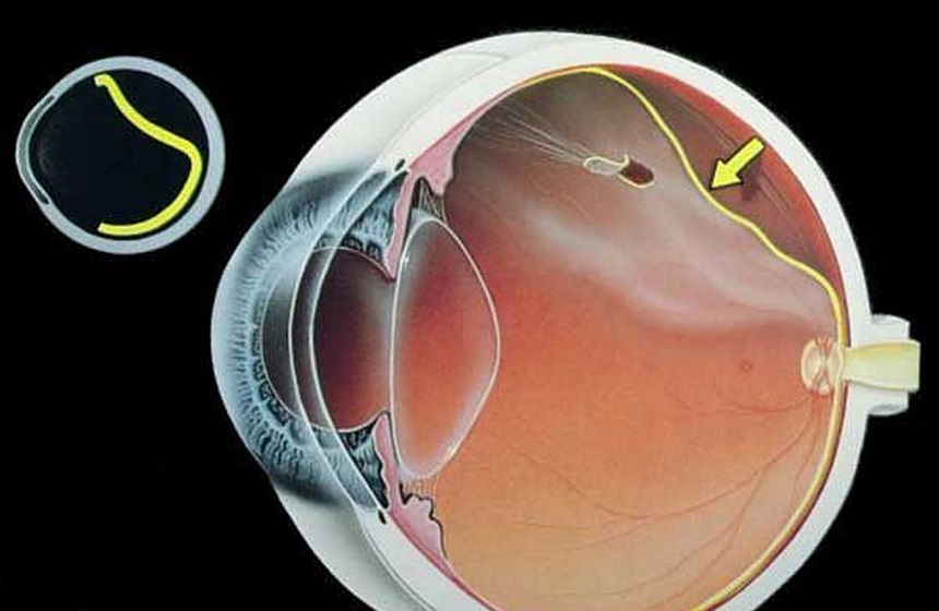 Desprendimiento de retina