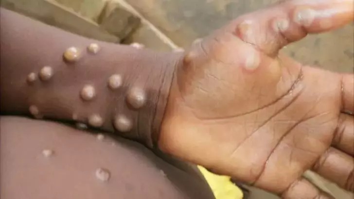 Dünya Sağlık Örgütü (DSÖ) Uluslararası Sağlık Tüzüğü Acil Durum Komitesi, maymun çiçeği (mpox)