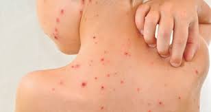 10 langkah yang boleh diamalkan apabila demam campak 