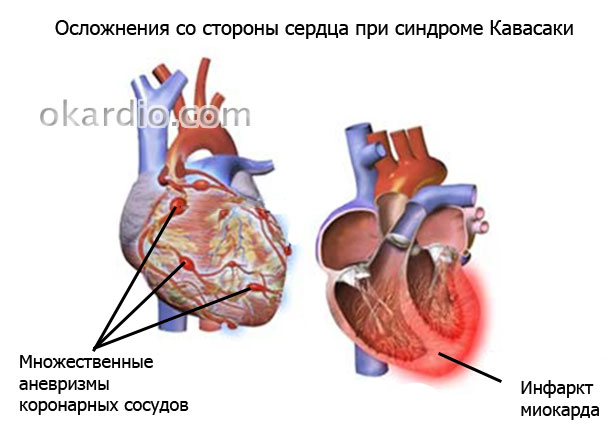 Симптомы болезни кавасаки. Кавасаки болезнь. Синдром Кавасаки: симптомы, диагностика и лечение