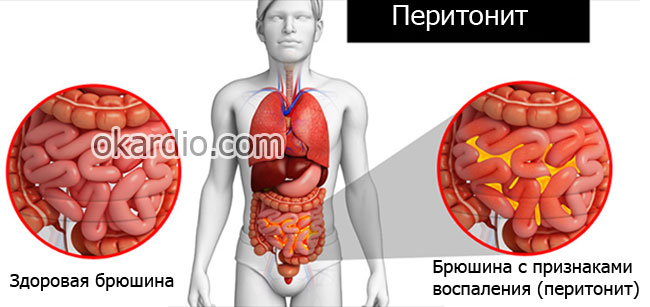 Тромбоз сосудов брюшной полости. Мезентериальный тромбоз