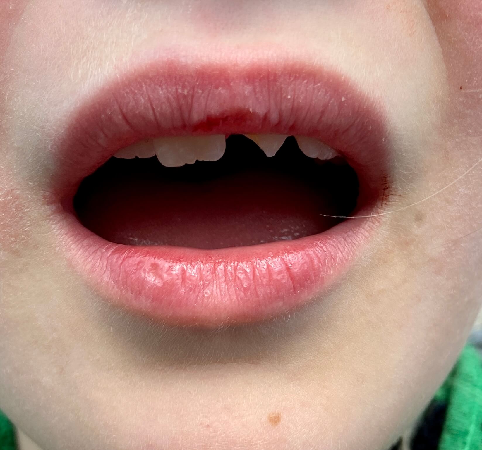 Tand afgebroken bij mijn kind, help wat moet ik doen?