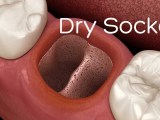 What Is A Dental Dry Socket Omega Dental Houston Tx