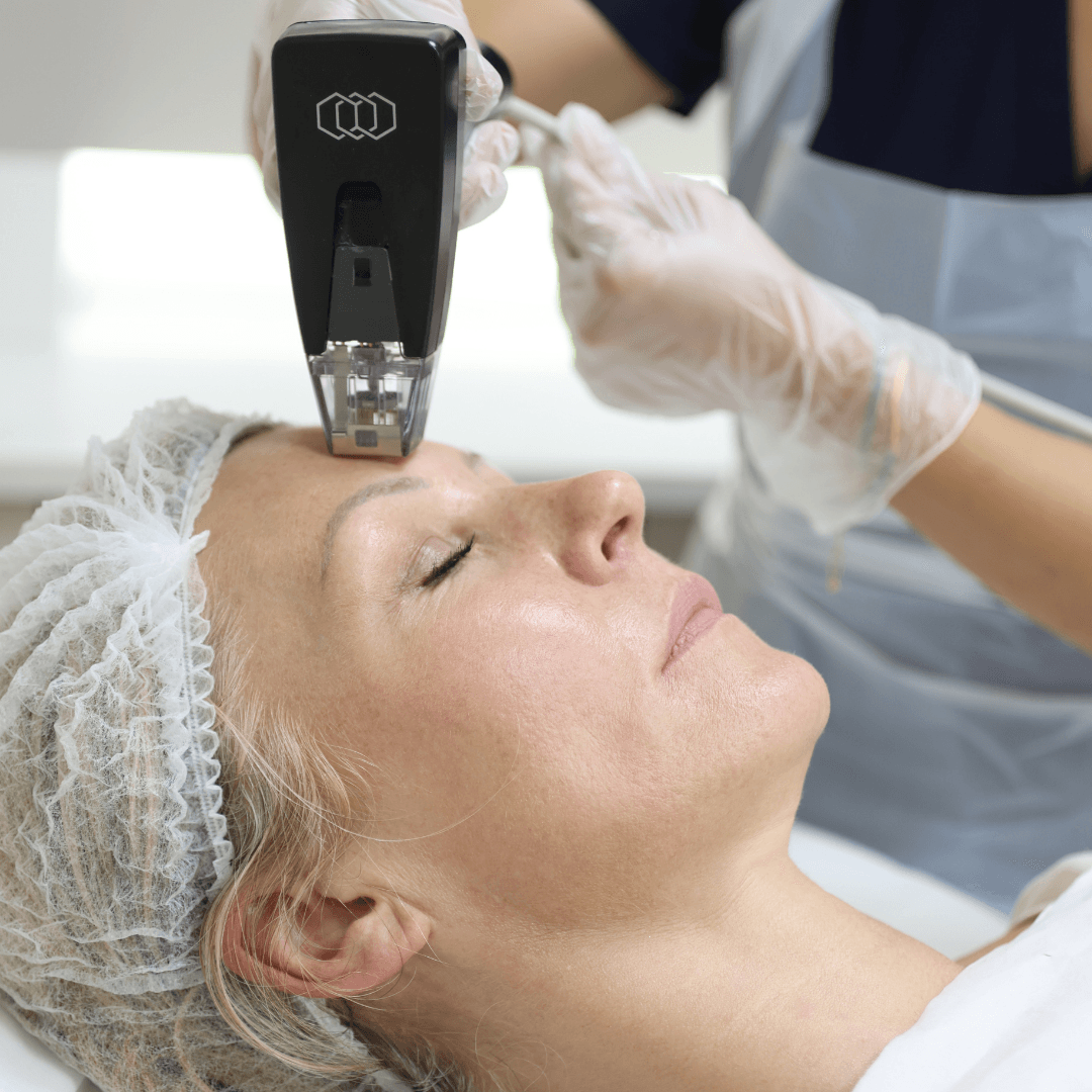 Morpheus8 treatment in London being performed on forehead