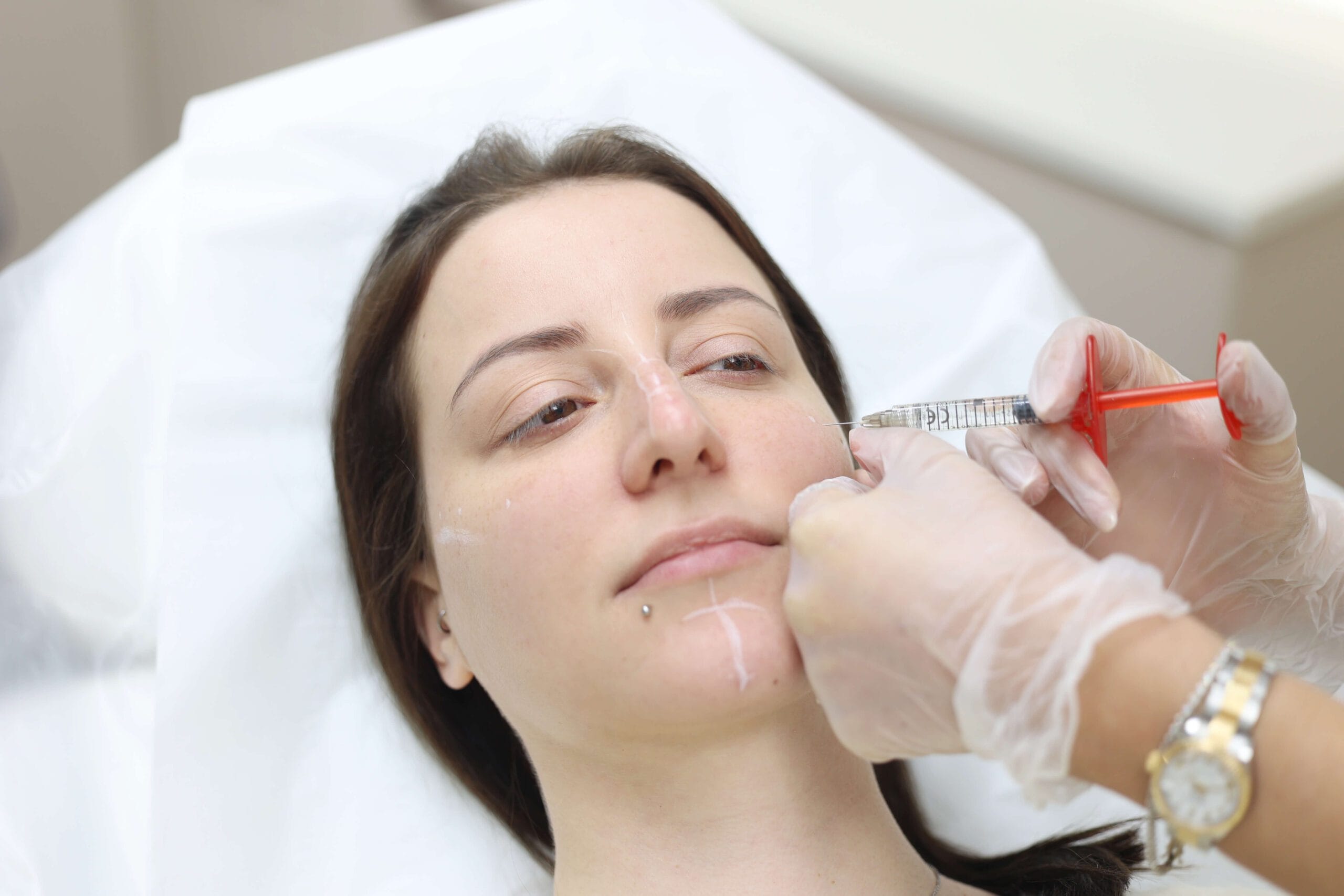 Dermal Fillers for the cheek and tear trough performed by dr Mariam michail