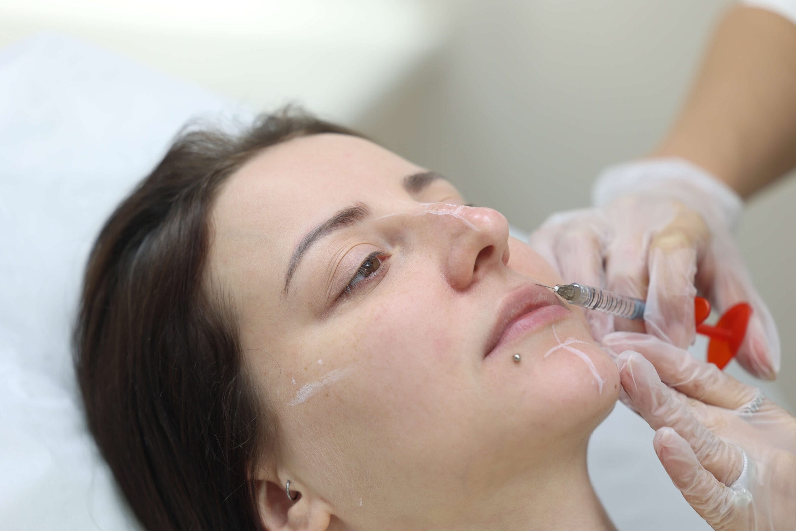 Lip fillers performed by Dr Mariam Michail