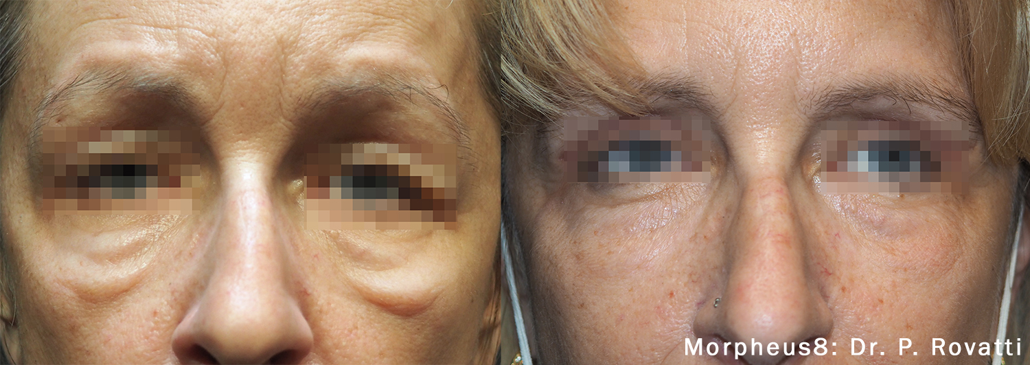 morheus8 eyes before and after image of real patient