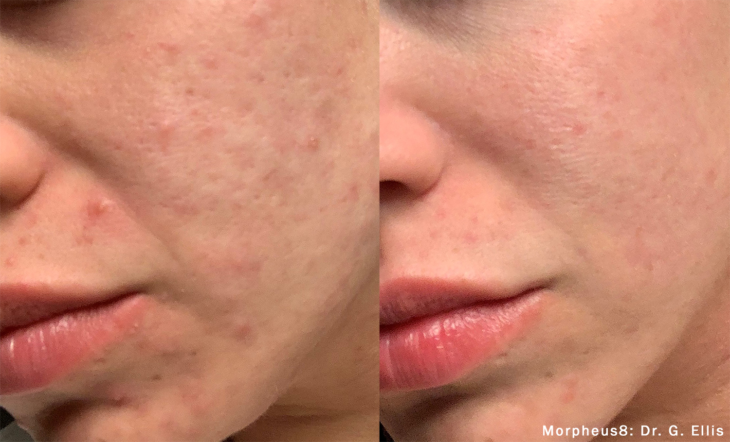 Morpheus8 Before and After face skin concern acne