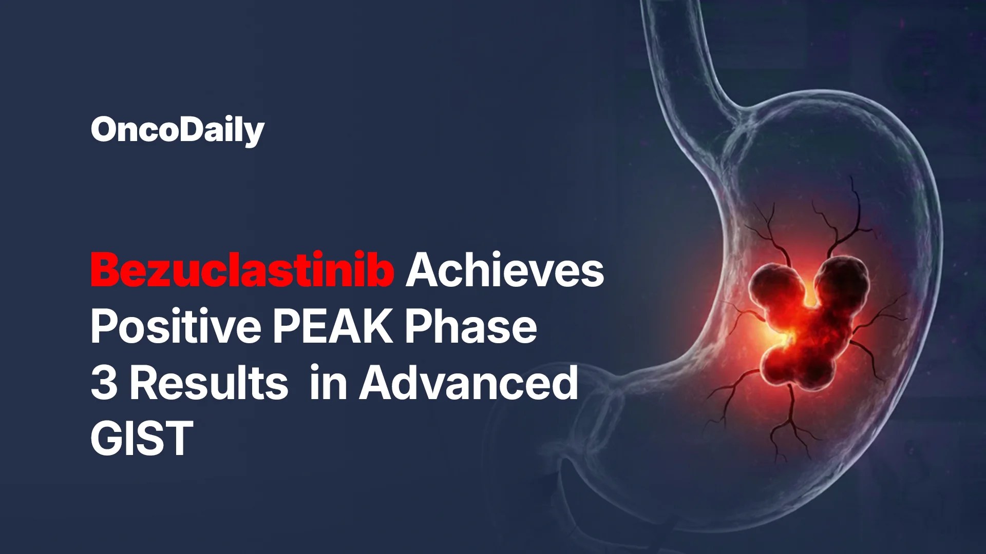 Bezuclastinib Breakthrough in GIST: Positive PEAK Phase 3 Results for KIT Mutations (2026)