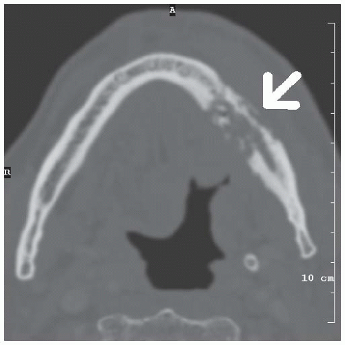General Principles of Head and Neck Pathology | Oncohema Key