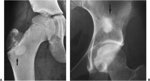 In benign enostosis, or bone islands, which also have sclerotic rounded lesions, the peripheral margins tend to blend or merge with the . Bone Forming Osteogenic Lesions Oncohema Key