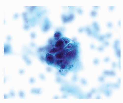 Squamous cell carcinoma