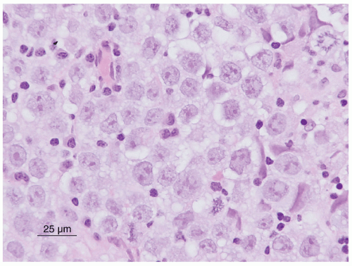 Embryonal and Pineal Region Tumors | Oncohema Key