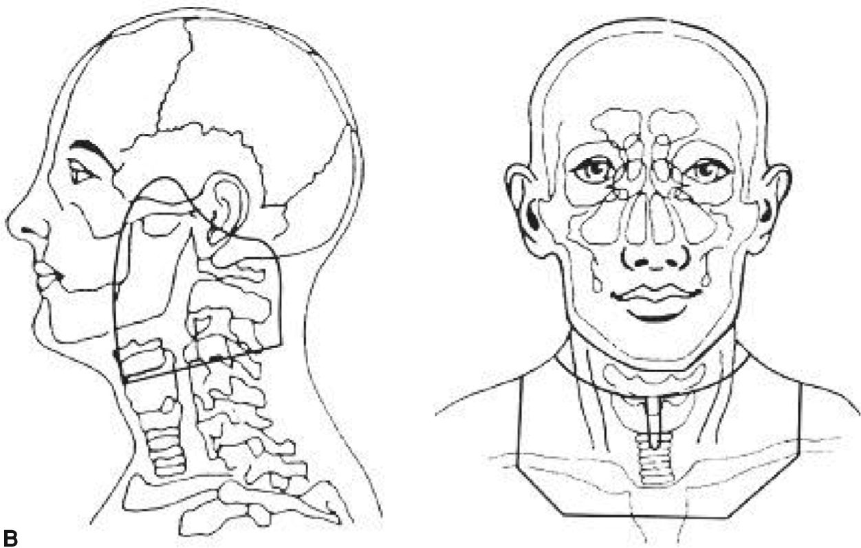 Head And Neck Cancer Of Unknown Primary Oncohema Key