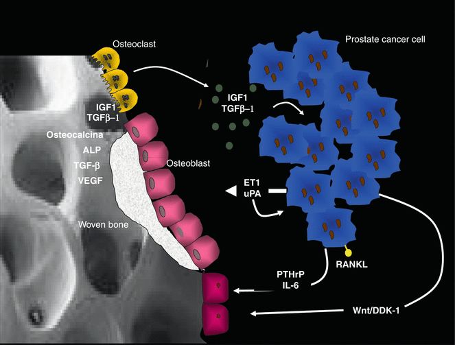 Biology and Pathophysiology of Bone Metastasis in Prostate Cancer ...