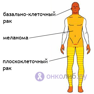 Солидная базалиома с изъявлением. Что такое базалиома кожи? Виды базалиомы. Факторы риска базалиомы
