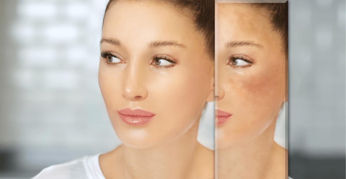5 best ingredients for rosacea skin care