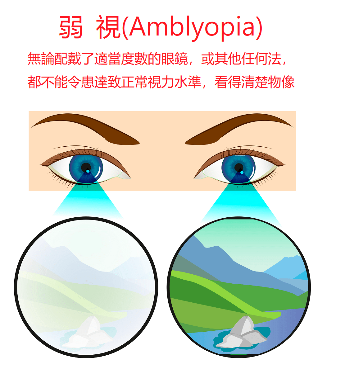 弱視原因弱視的種類與原因 全民愛健康 Ropux