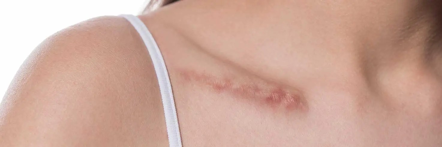 How Scar Reduction Boosts Skin Health & Transforms the Skin?