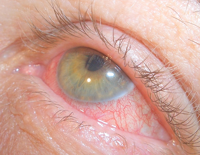 20+ Great Rheumatoid Arthritis Blindness : What Color Blind People See - Health - Arthritis is a general term for a group of painful conditions that involve inflammation and stiffness of the joints.