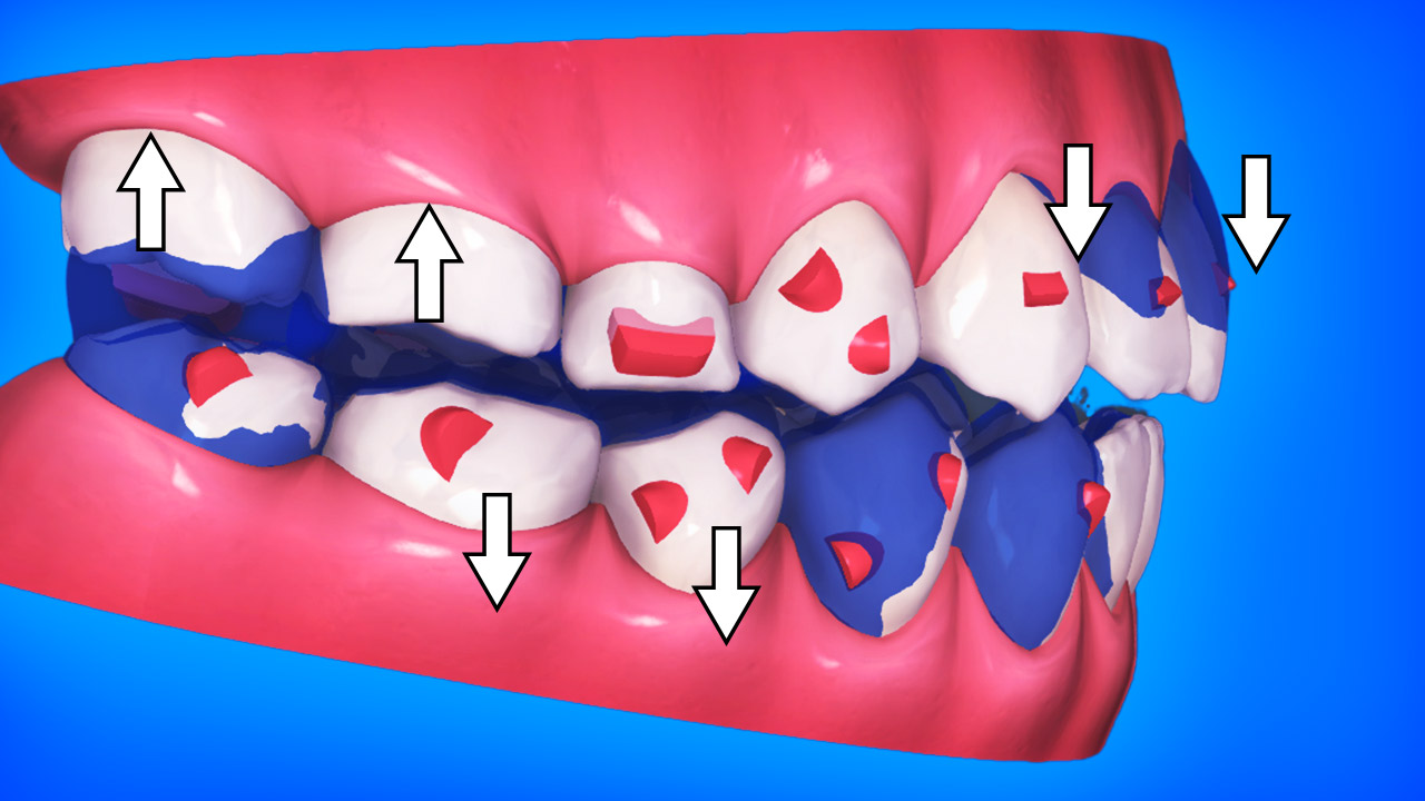 Biomechanics for clear aligner open bite cases