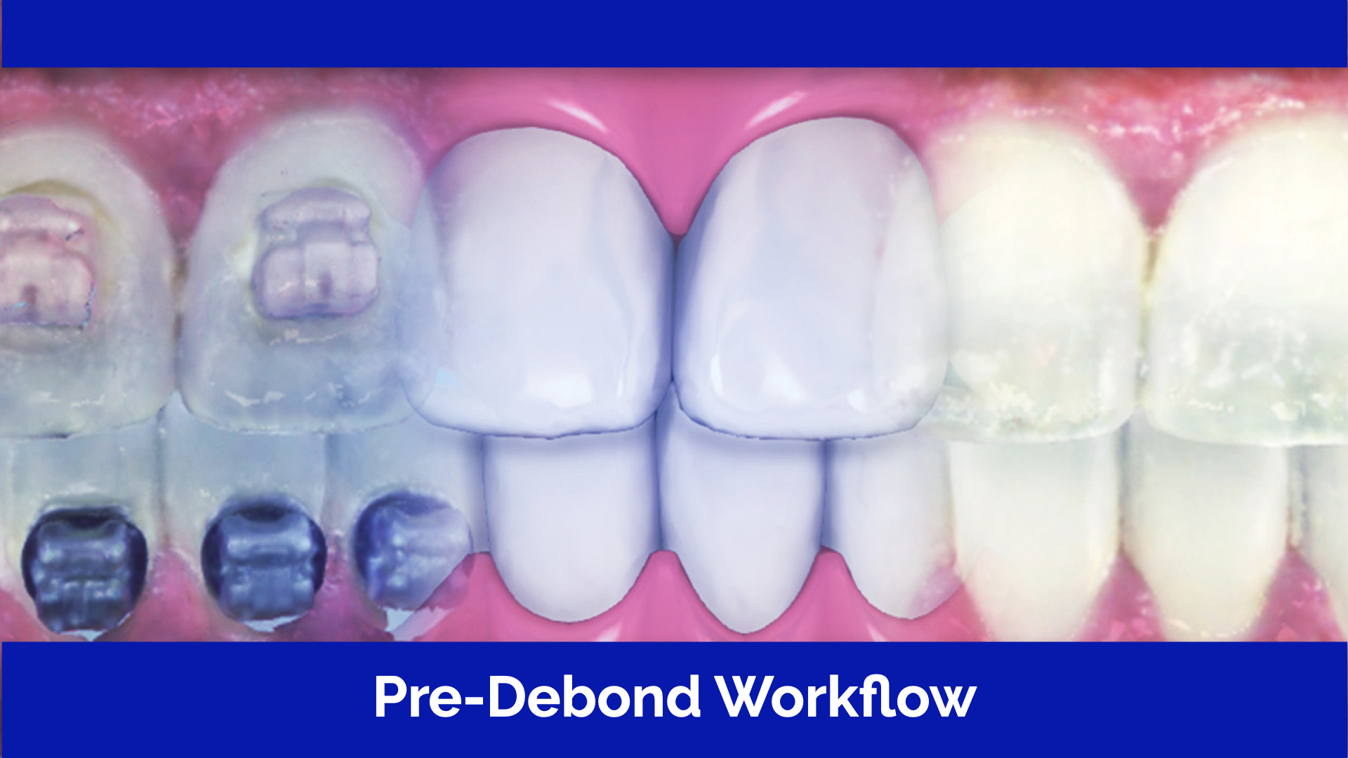 [Premium] Pre-debond Workflow & Digital Removal Of Brackets