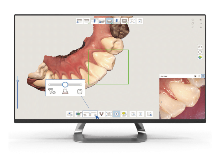 Smart Scan Filtering口腔内スキャン時に不要な軟組織データが自動的に削除されるようになりました。​