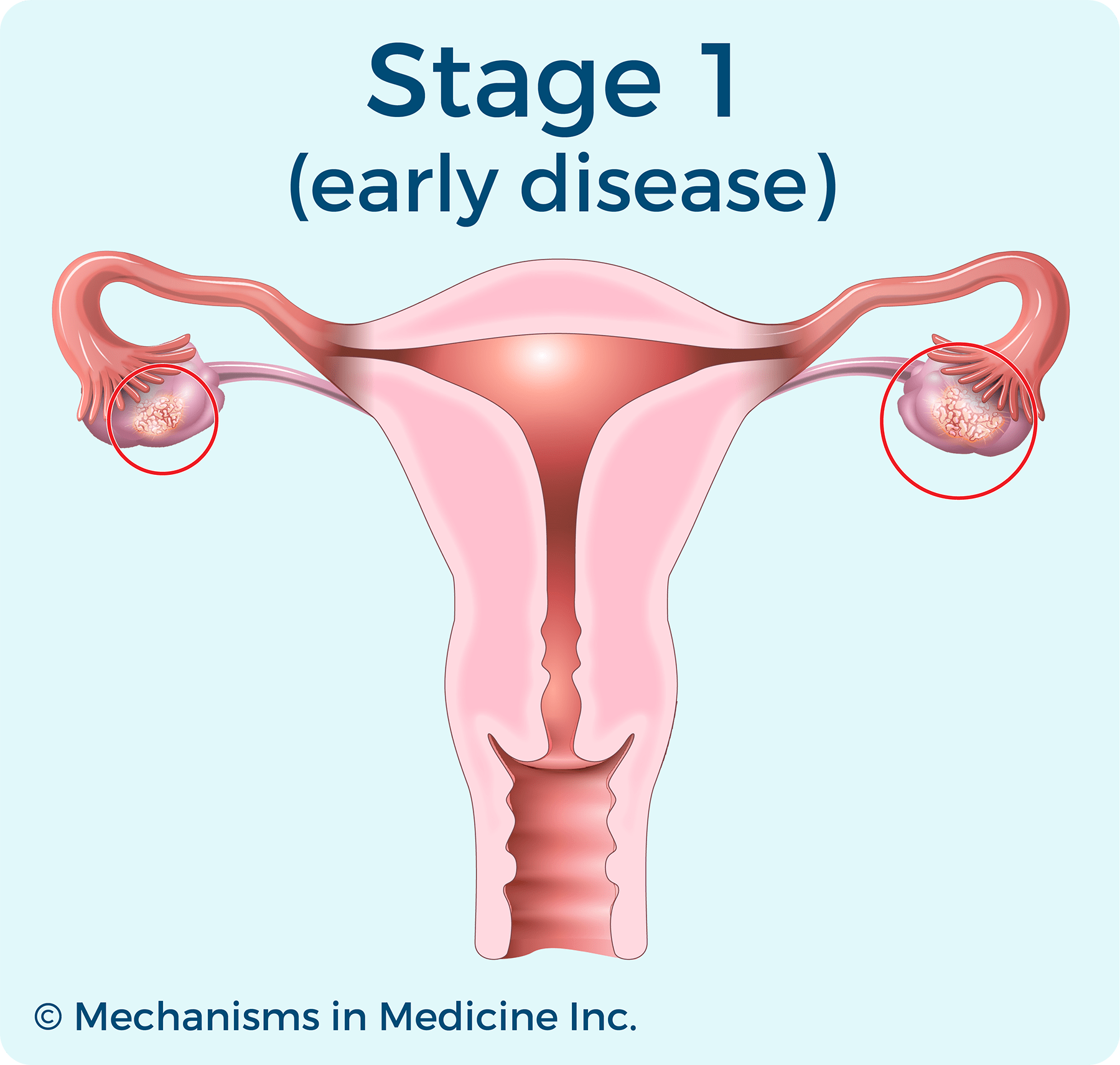 Ovarian Cancer | Stage 1