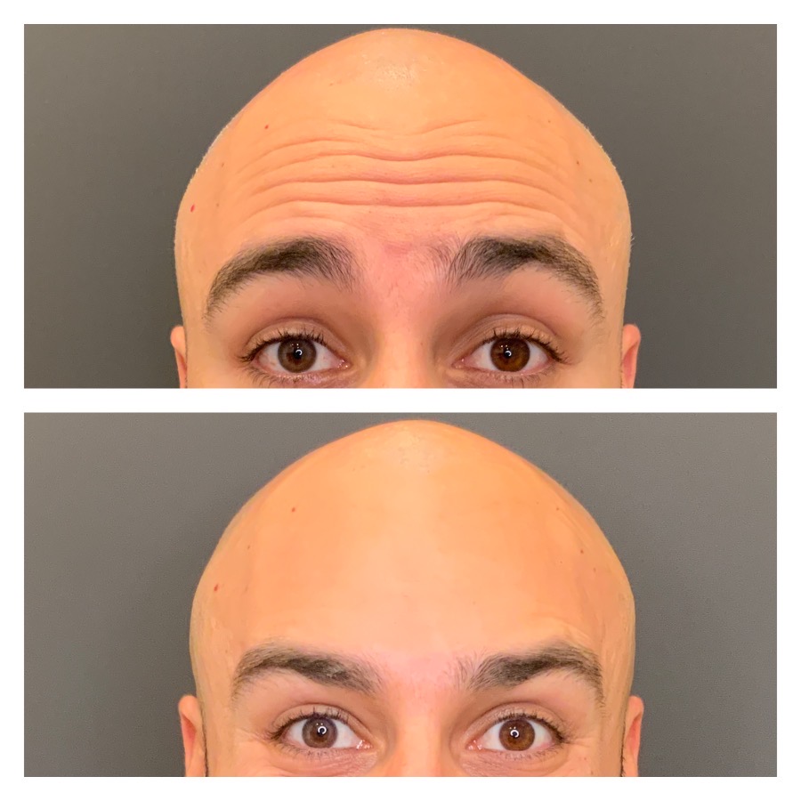 Botox/Nuceiva before and after Vancouver