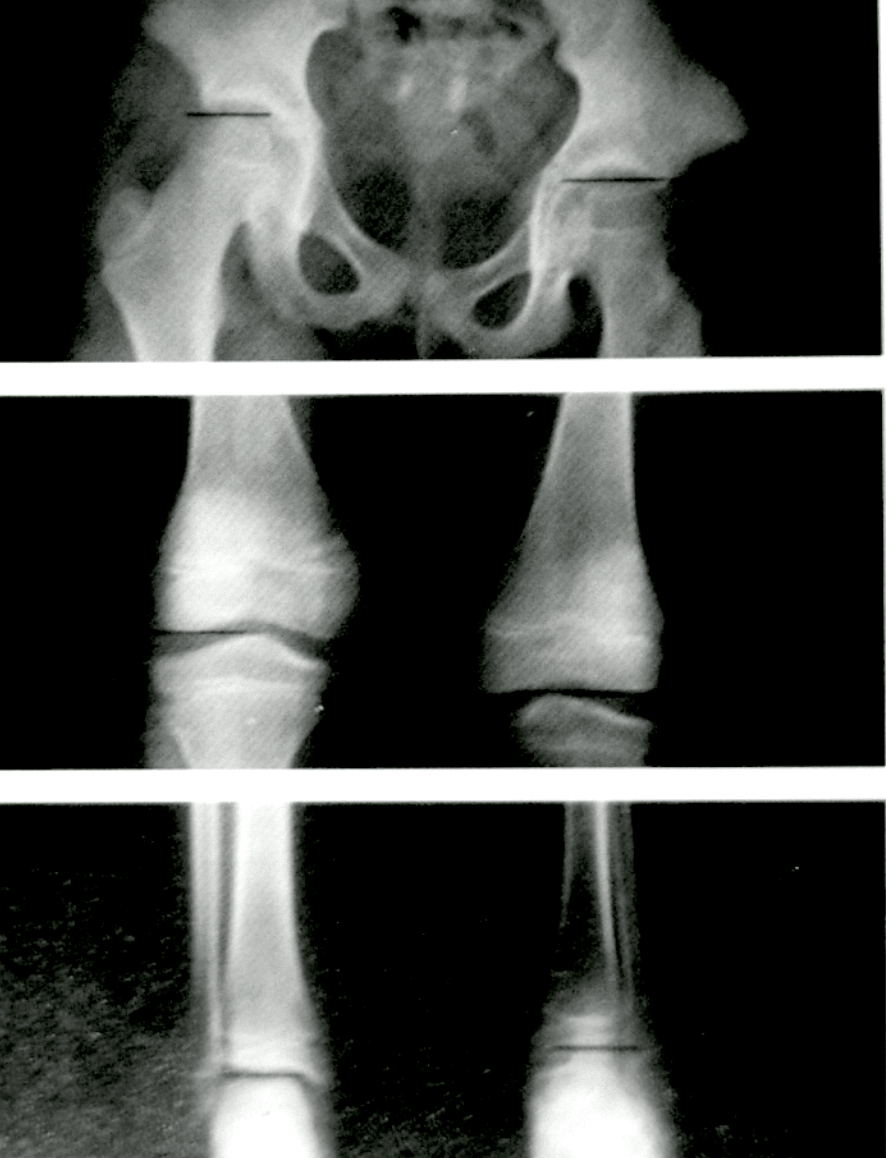 Galeazzi Test LegLength Discrepancy Lower Extremity Problems In
