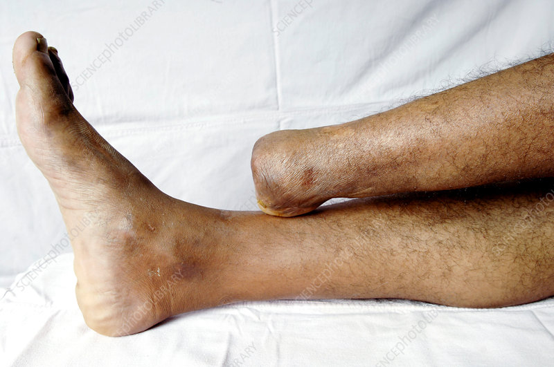 Amputated foot