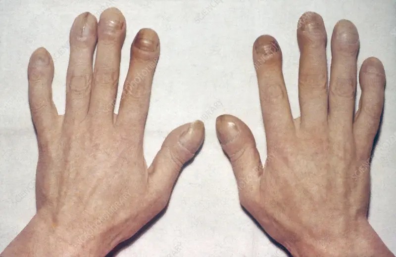 Hypertrophic Osteoarthropathy