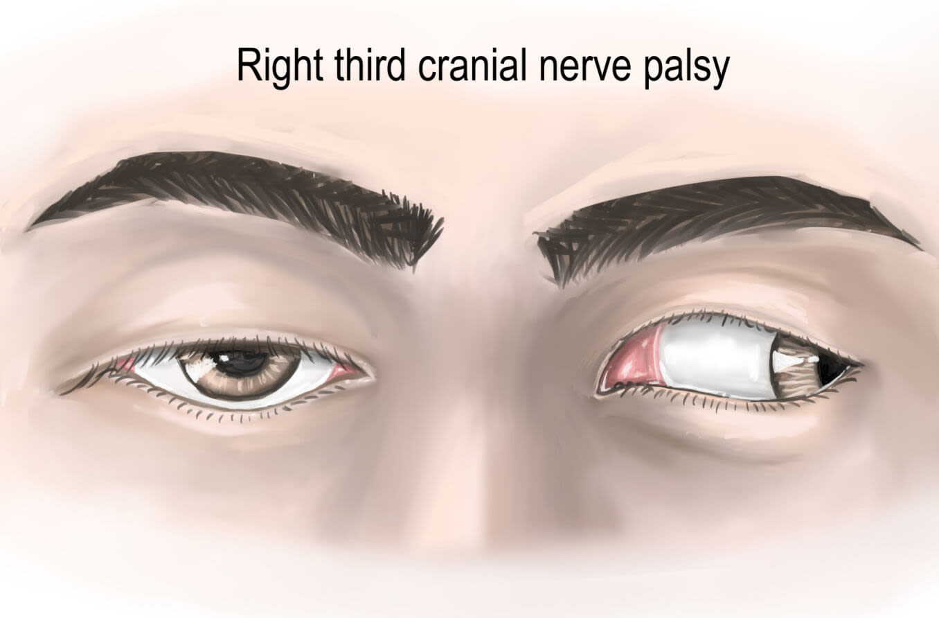 third_cranial_nerve_palsy_hero