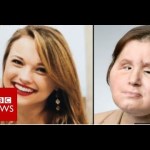 Coping with our daughter's new face – BBC News