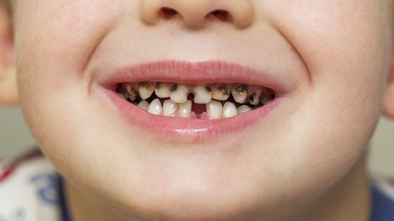 Pediatric Dentist in Junagadh Children Dental Clinic In Junagadh Kids Dentist In Junagadh