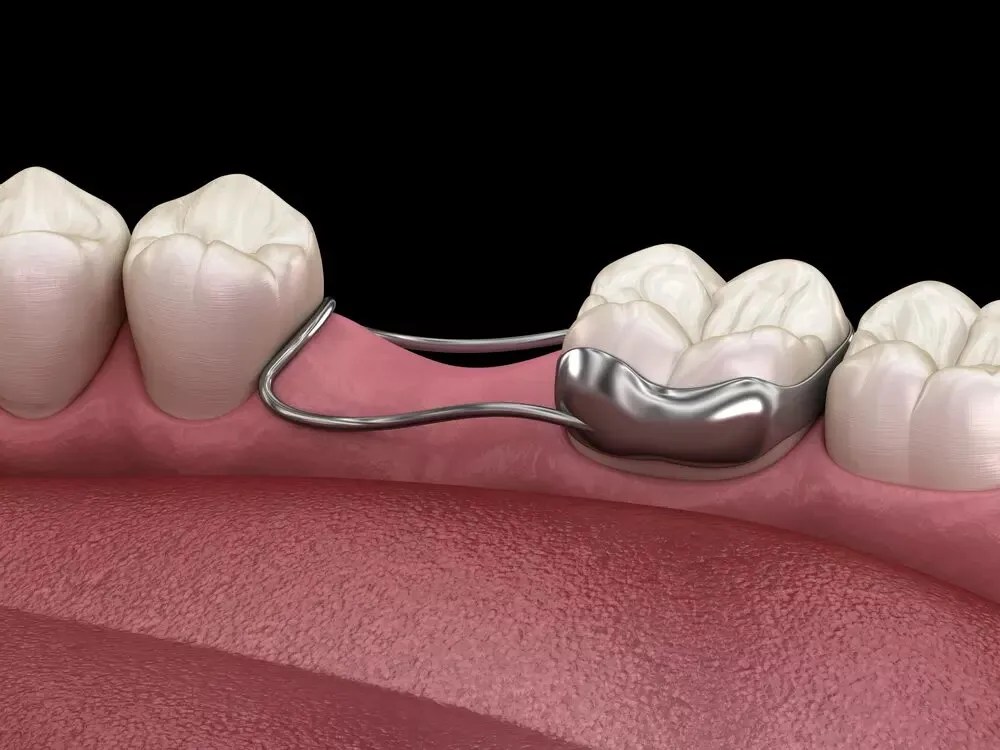 band and loop space maintainer, pediatric dentist in Junagadh, kids dentist Junagadh, Parshvi Dental Care Junagadh, children dental clinic Junagadh, space maintainer for kids, baby tooth loss treatment, early tooth loss in children, dental space maintenance Junagadh, pediatric dentistry Junagadh, best children dentist Junagadh, dental care for kids Junagadh, band and loop dental device, space maintainer procedure Junagadh, dental treatment for kids, child tooth replacement Junagadh, oral health for children, preventive dental care for kids