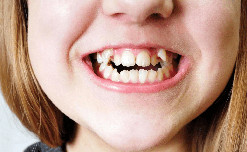Pediatric Dentist in Junagadh, Children Dental Clinic in Junagadh, Kids Dentist in Junagadh, Best Pediatric Dentist Junagadh, Child dental care in Junagadh, Gum disease treatment for kids Junagadh, Pediatric gum care Junagadh, Kids oral health clinic Junagadh, Baby teeth and gum care Junagadh, Pediatric dental treatment Junagadh, Early dental care for children Junagadh, Dental check-up for kids Junagadh, Kids cavity and gum treatment Junagadh, Child-friendly dentist Junagadh, Pediatric dentistry Junagadh, Best children dental clinic Junagadh, Dr. Bhumika Hirpara dentist Junagadh, Preventive dental care for kids Junagadh, Kids oral hygiene Junagadh, Gum disease prevention in children Junagadh, Pediatric oral health Junagadh