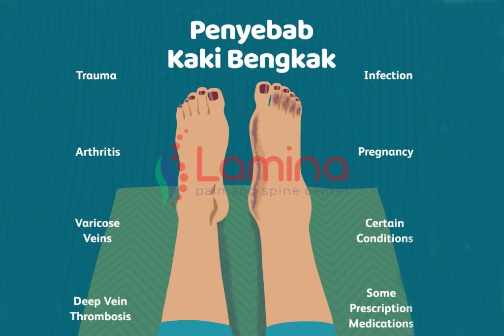 Kaki bengkak kenali gejala dan penyebabnya